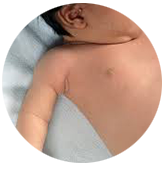 Parálisis plexo braquial obstétrica (PBO) Parálisis plexo braquial obstétrica (PBO)